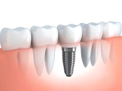 dental implants - oral surgery high Park Toronto