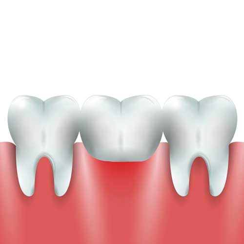 Dental Bridges - Dental Office in High Park