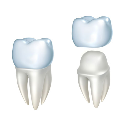 Dental Crowns - High Park Dentist