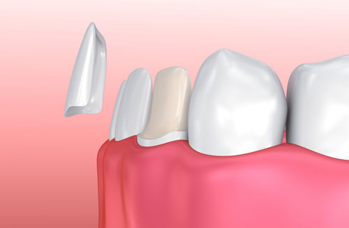 Porcelain Veneers - Cosmetic Dentistry in High Park Toronto