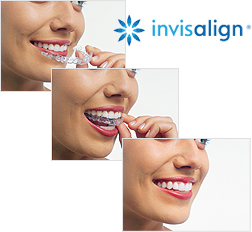 Invisalign - High Park Invisalign Dentist